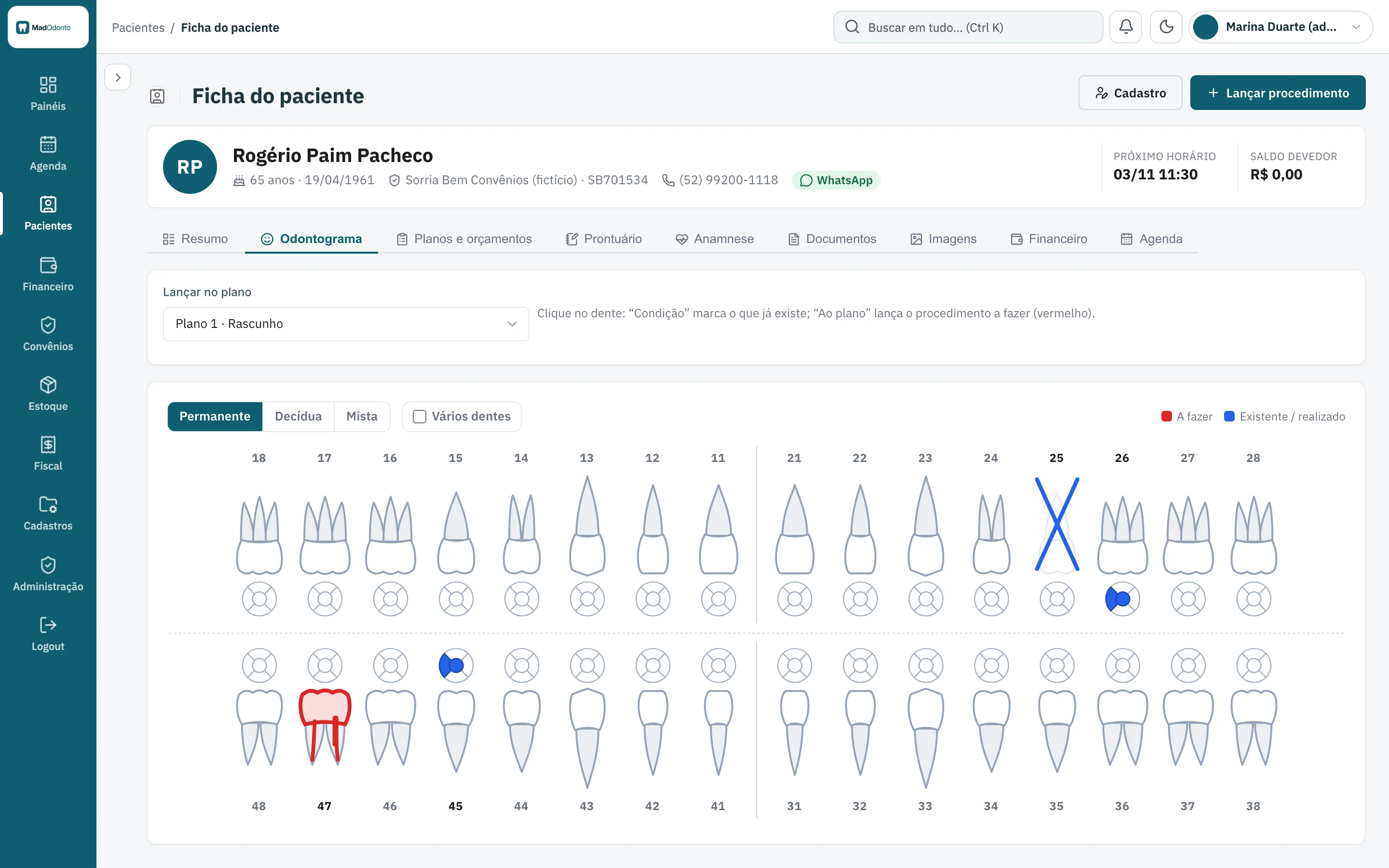 Odontograma da ficha do paciente no MadOdonto: o que já existe em azul e o procedimento a fazer em vermelho, por dente e face